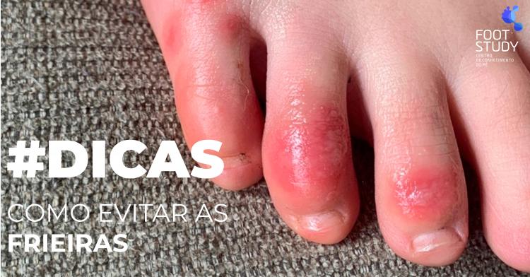How to avoid chilblains