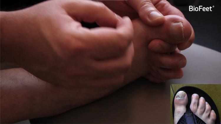 Treatment of Onychomycosis - Clinical Case 01 